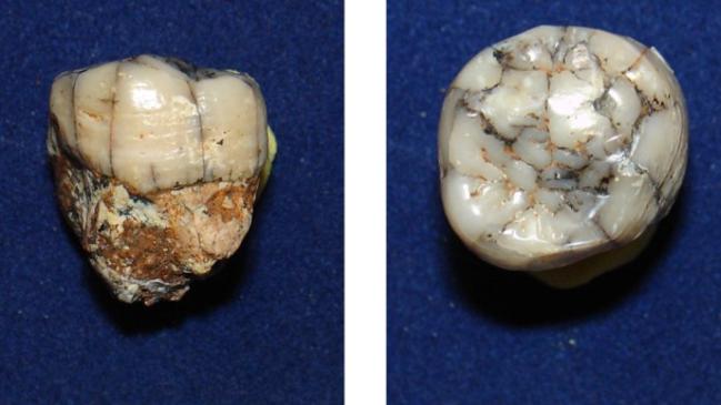 An undated picture provided by the Press Office of the Senckenberg Research Institute on January 4, 2016, shows examined tooth of Gigantopithecus from Thailand. The Gigantopithecus, a giant gorilla that looks like King Kong, disappeared a million years ago from the surface of the Earth due to the inability to adapt to environmental changes according to scientists. / AFP / SENCKENBERG RESEARCH INSTITUTE / Yaowalak Chaimanee / RESTRICTED TO EDITORIAL USE - MANDATORY CREDIT "AFP PHOTO / SENCKENBERG RESEARCH INSTITUTE / YAOWALAK CHAIMANEE" - NO MARKETING NO ADVERTISING CAMPAIGNS - DISTRIBUTED AS A SERVICE TO CLIENTS