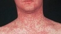 A typical measles rash. Picture: Victoria Department of Health