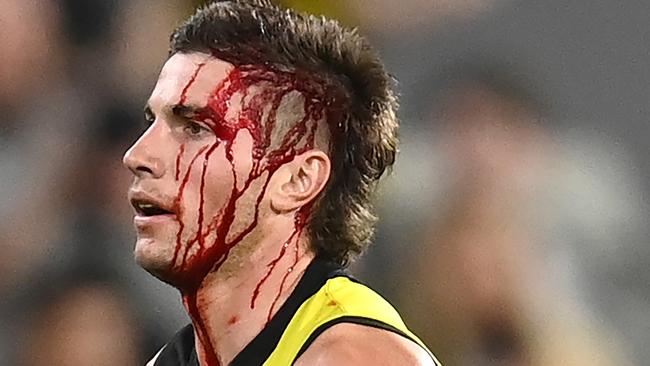 Liam Baker leaves the field bleeding against the Bulldogs. Picture: Quinn Rooney/Getty Images