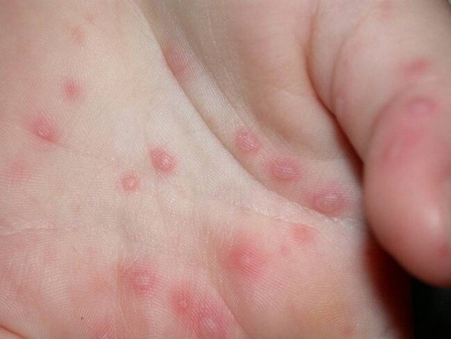 Hand, foot and mouth disease is a self-limiting illness (gets better by itself), caused by the Coxsackie virus.