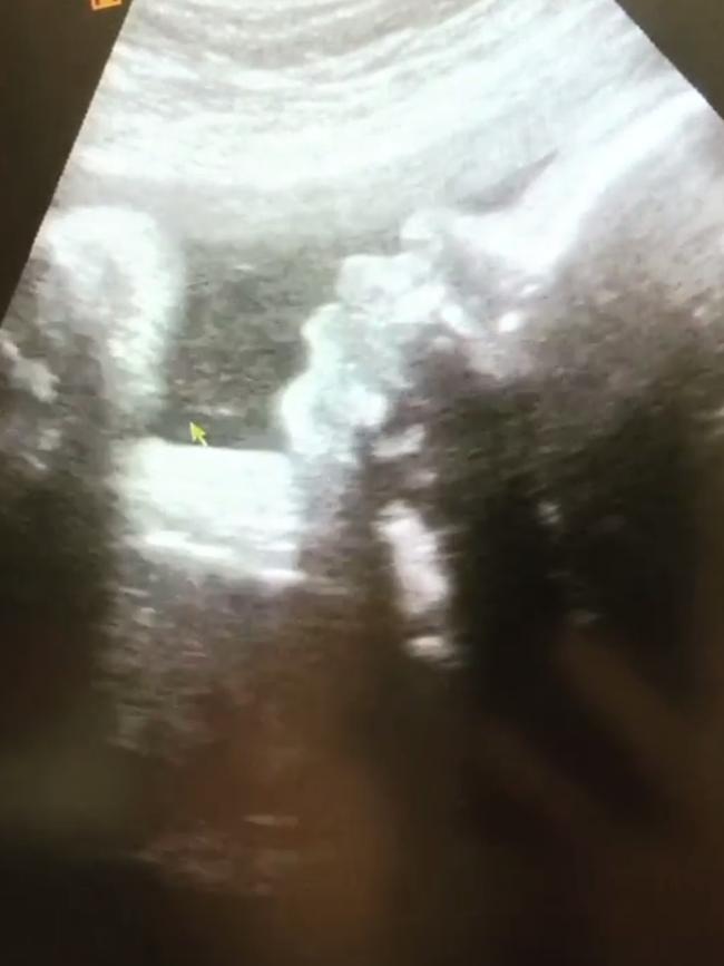 Sunrise presenter Bartholomew announced her pregnancy live on air sharing an ultrasound of the couple’s baby. Picture: Instagram