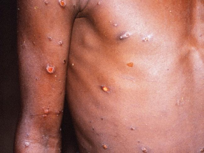 A person suffering from monkeypox. Picture: Alamy