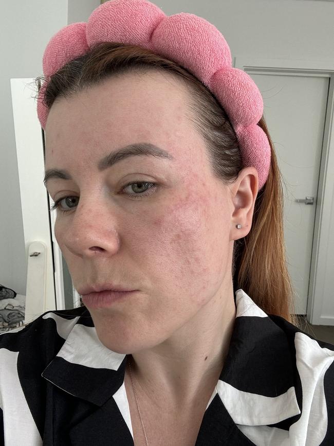 My face became angry, red and inflamed after I used a product on it that had been exposed to oxygen, damaging the formula. Picture: Supplied/RebekahScanlan