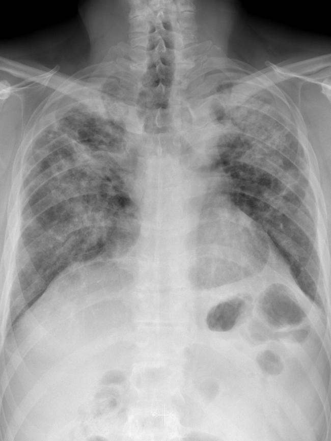 Compared to a X-ray of someone with severe silicosis with progressive massive fibrosis. Picture: Case courtesy of Bruno Di Muzio, <a href="https://radiopaedia.org/cases/silicosis-with-progressive-massive-fibrosis-8" title="radiopaedia.org">Radiopaedia.org, rID: 64019</a>