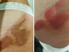 Aussie’s warning after mysterious Bali scar