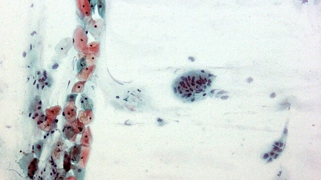 Normal cervical cells following a pap smear. Picture: Medical / Pap Smear.