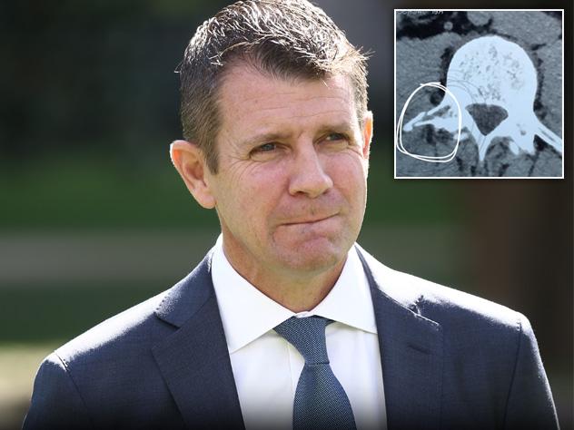Premier fractures vertebrae in stair fall