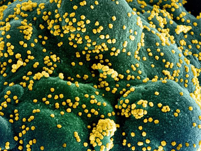 (FILES) In this undated handout image obtained July 15, 2020, courtesy of National Institute of Allergy and Infectious Diseases(NIH/NIAID), shows a colorized scanning electron micrograph of an apoptotic cell (blue/green) heavily infected with SARS-COV-2 virus particles (yellow), isolated from a patient sample, captured at the NIAID Integrated Research Facility (IRF) in Fort Detrick, Maryland. - US pharmaceutical company Eli Lilly's combination of two synthetic antibodies against Covid-19 reduced hospitalizations and deaths by 70 percent in high-risk patients with recent positive tests, the company said on January 26, 2021. "Bamlanivimab and etesevimab together have the potential to be an important treatment that significantly reduces hospitalizations and death in high-risk COVID-19 patients," Lilly's chief scientific officer Daniel Skovronsky said. (Photo by Handout / National Institute of Allergy and Infectious Diseases / AFP) / RESTRICTED TO EDITORIAL USE - MANDATORY CREDIT "AFP PHOTO /NATIONAL INSTITUTE OF ALLERGY AND INFECTIOUS DISEASES/HANDOUT " - NO MARKETING - NO ADVERTISING CAMPAIGNS - DISTRIBUTED AS A SERVICE TO CLIENTS