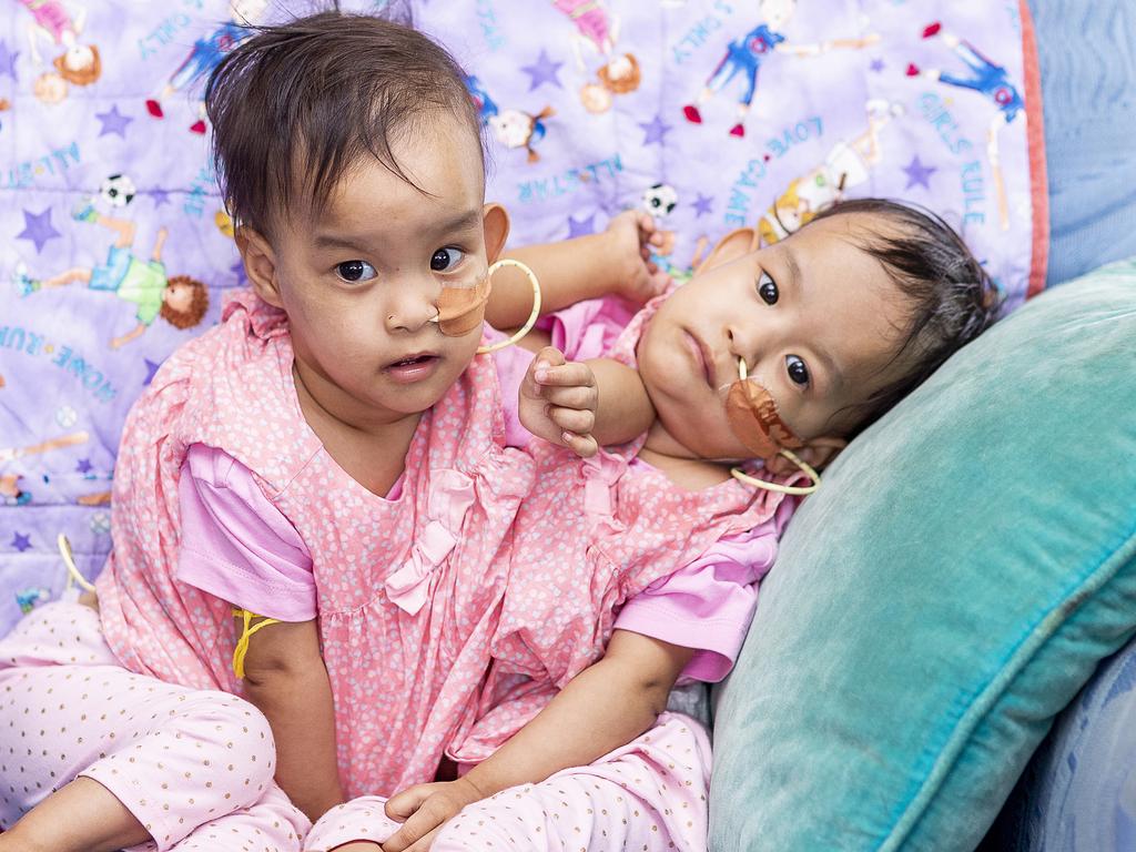 Conjoined Bhutanese Twins Undergo Separation Surgery In Melbourne