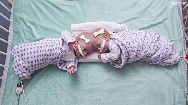 Conjoined twins Erin and Abby Delaney have been successfully separated in an 11 hour surgery.