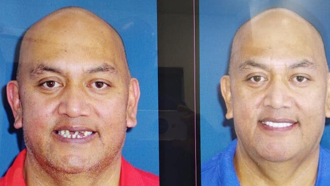 Thomas Teneti before and after his dental makeover provided by WA Dental. 