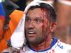 Bloody injury exposes ‘toxic’ NRL problem