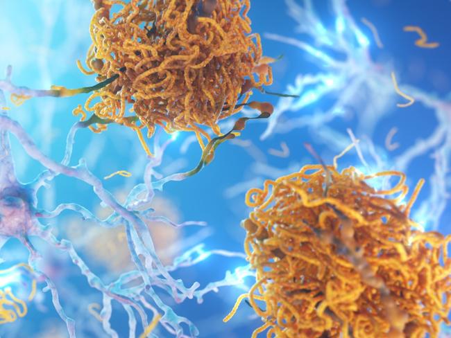 Amyloid plaques responsible for Alzheimer's disease. Image: Supplied.