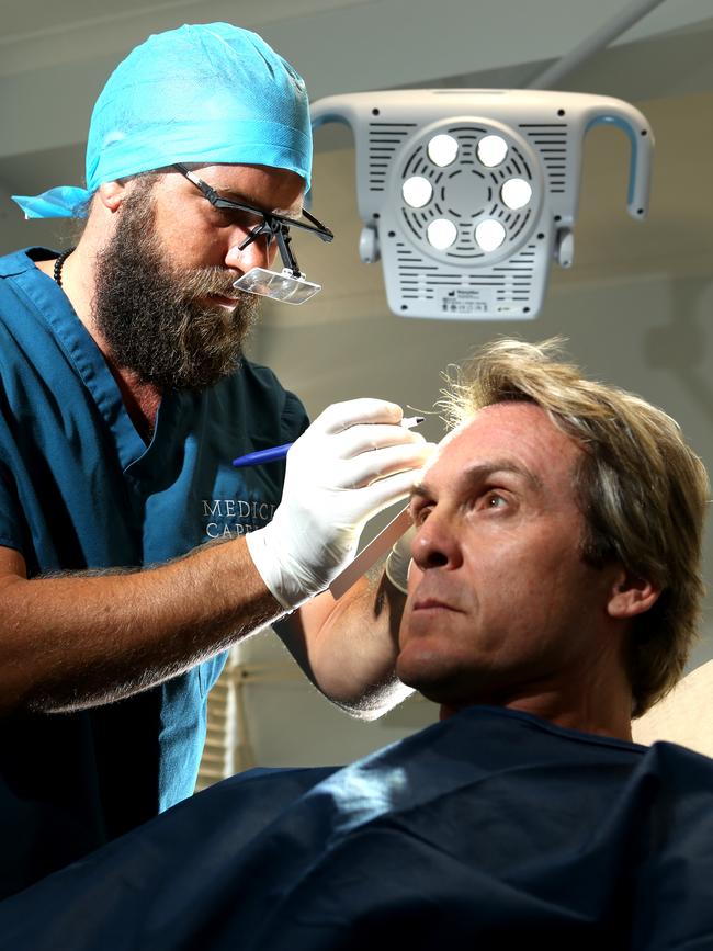 A man receives a hair transplant. Picture: Glenn Hampson