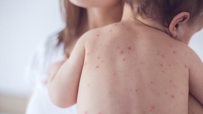 Measles is a highly infectious viral disease that can cause serious illness, particularly in very young children and adults.