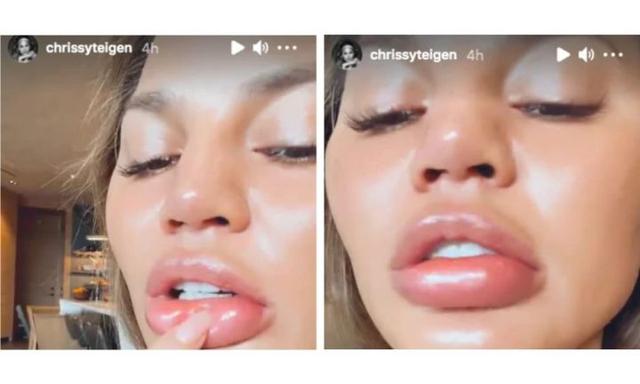 Image result for Chrissy Teigen lips swallen