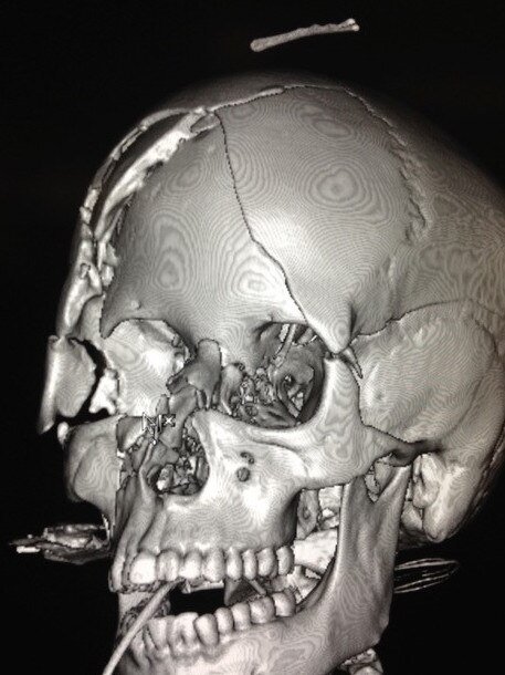 X Ray of Simone O'Brien who was left fighting for her life in 2012 after being bashed repeatedly by a baseball bat.