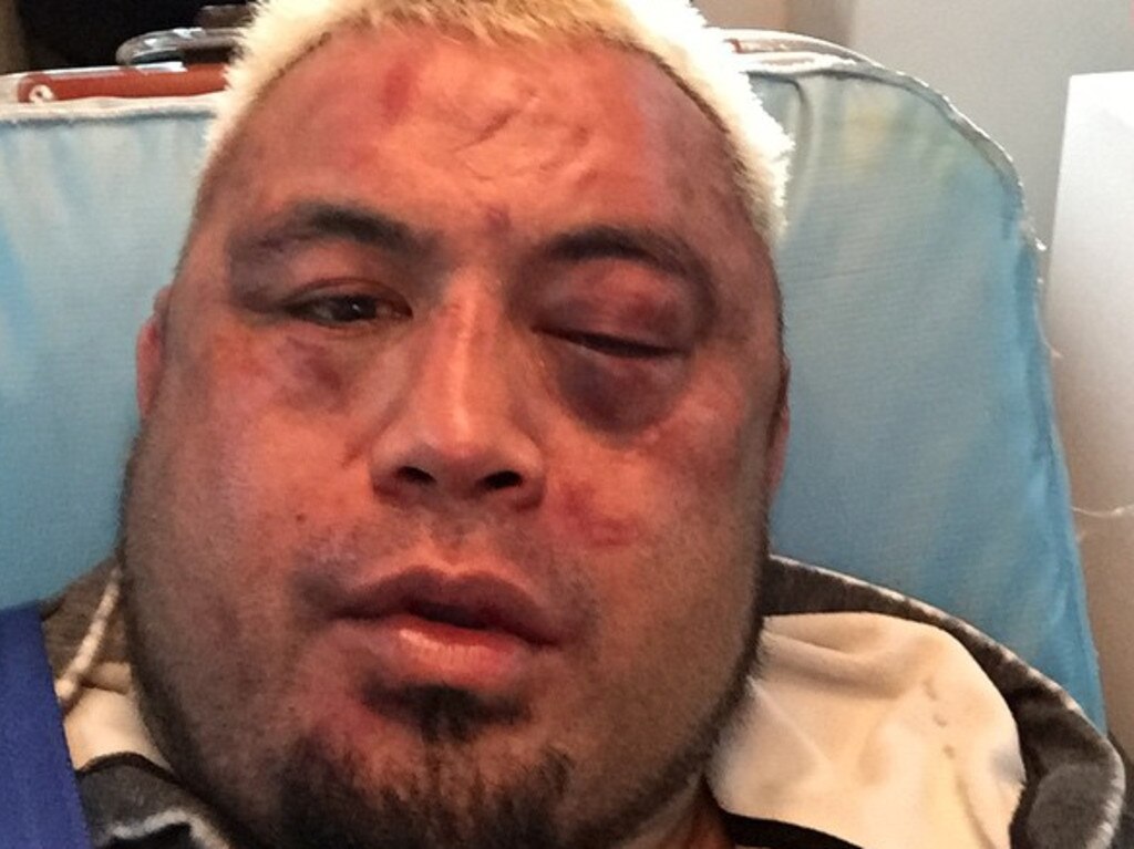 Mark Hunt looks worse for wear after his loss to Stipe Miocic in 2015.