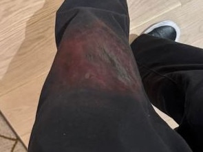 Barker's pants were covered in blood from the injury.