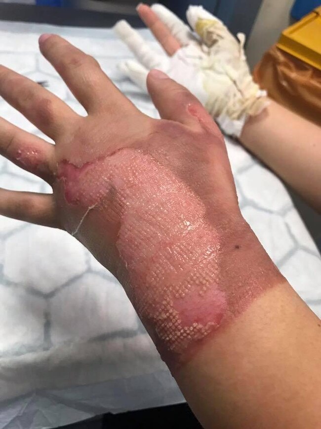 Teen Maya Edwards' horrific injuries after suffering third degree burns while doing her NAILS. Picture: Triangle News