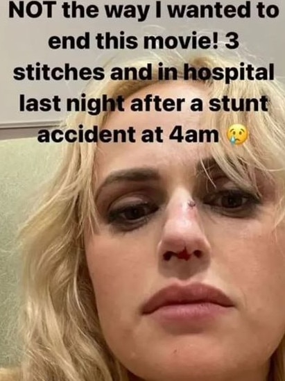 The actress first revealed her injury last week on Instagram.