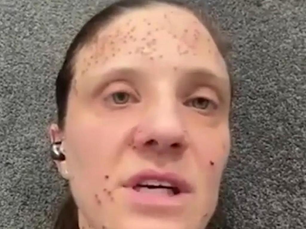 Ms Solari has neurofibromatosis, a genetic disorder that causes non-cancerous tumours to grow in the nervous system and skin anywhere across the body. Picture: KRCA 3