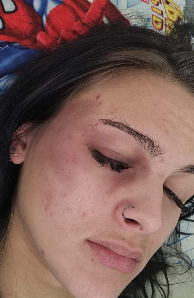 Sunshine Coast woman Chloe Heath's injuries following an alleged attack outside the Nambour Police Station in June last year.