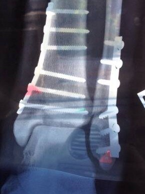 He had 12 screws and a plate put into his ankle and was told he may never run again. Picture: Supplied