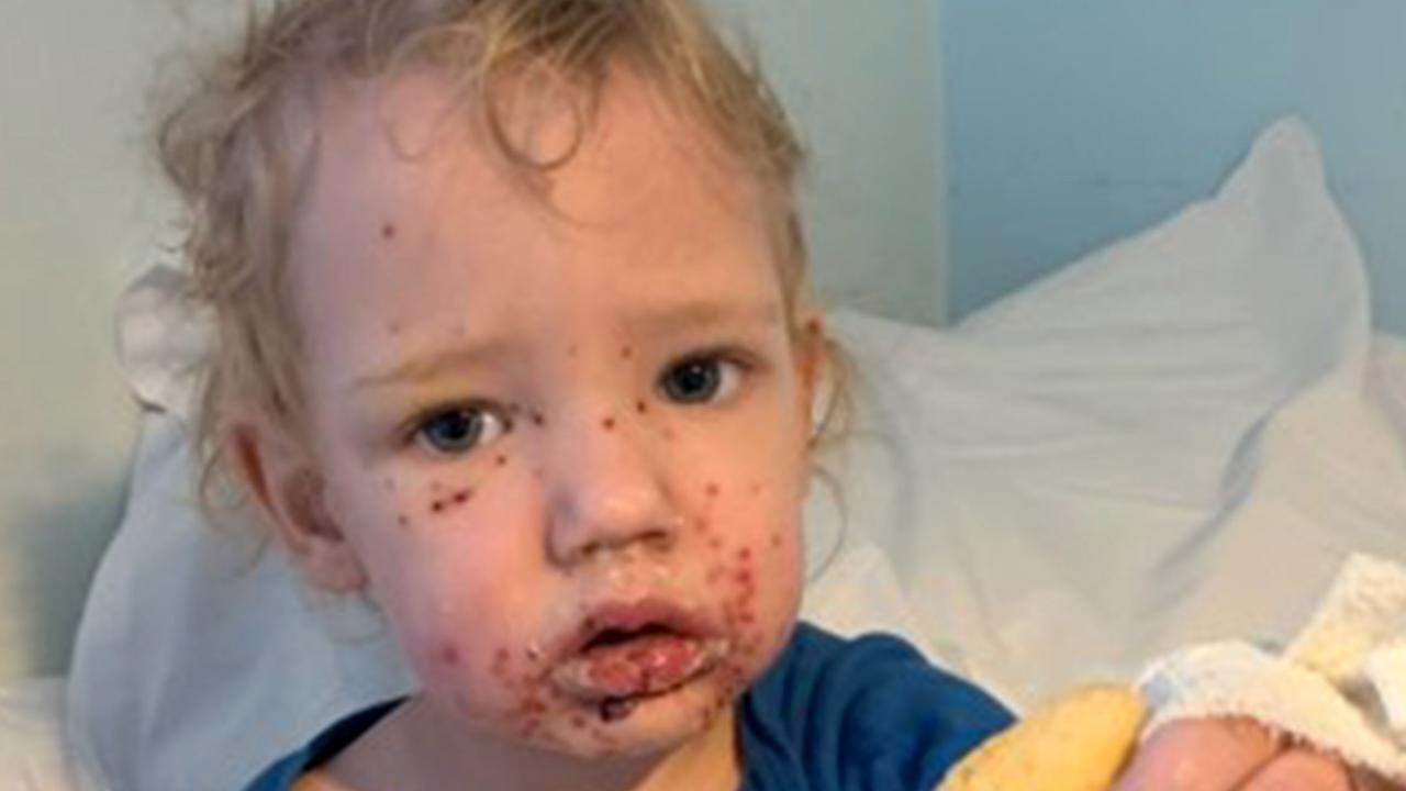 adorable-toddler-whose-face-was-eaten-alive-by-herpes-after-kissing