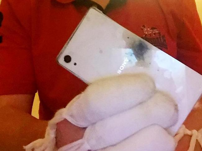 Tom Collins, 36, received third degree burns when his Sony Xperia Z2 smartphone burst into a flames as he was texting. Picture: SWNS/Mega