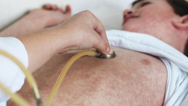 Measles generic. Picture: ACS