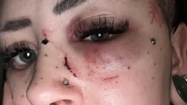 Ms Hellsten posted evidence of her injuries to TikTok.