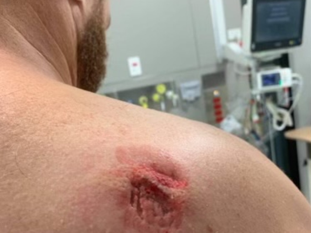 Bite marks on the shoulder of a man who the Health Services Union said was injured at Port Macquarie Base Hospital. Picture: Supplied via NCA NewsWire