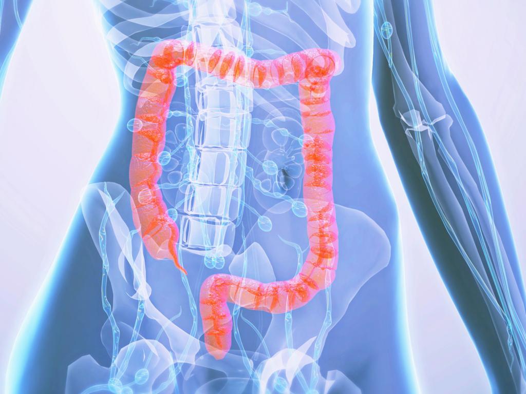 Bowel cancer is the fourth most common cancer in Australia. Picture: iStock