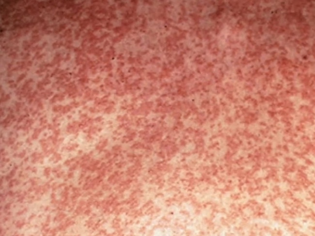 A measles case was detected at Sydney Airport in early March. Picture: Supplied