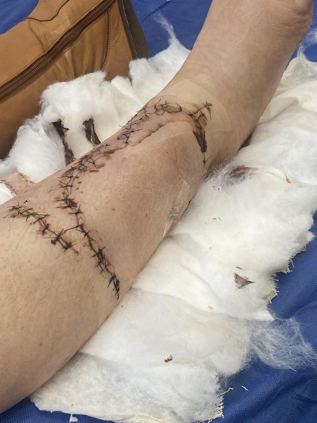 Pamela Cook’s injuries after surgery Picture: Supplied