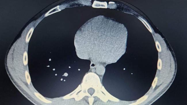 The impact of the diseases shown in this lung xray. Picture: Supplied