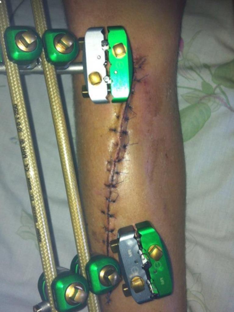 Image of Wests Tigers player Harry Grant leg after a car accident when he was a teenager- Picture Instagram