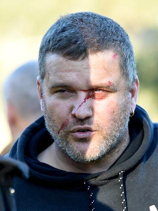 A man, understood to be the truck driver, nurses an injured eye. Picture: Nicole Garmston