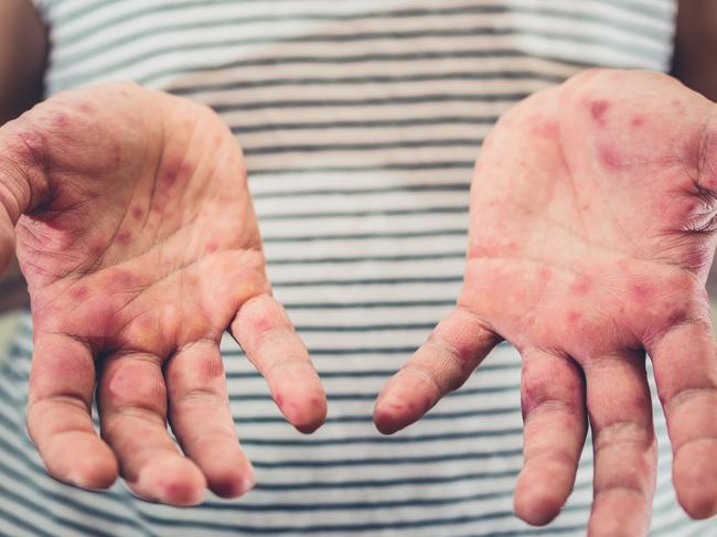 Measles, hand foot and mouth disease, istock