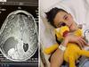 Doctors remove tennis ball-sized tumour from ‘brave’ teen’s brain