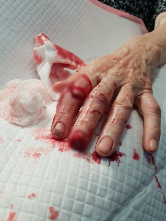 Wounds caused by a feral pig which latched onto Bette Willis' friend, Kay, while she was out in the garden.