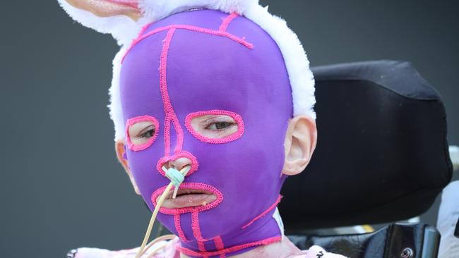 Corio burns victim Mavis Perry recovering at the Royal Children’s Hospital earlier this year. Picture: David Caird