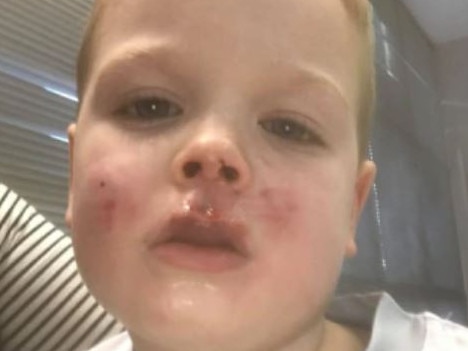 Joey Hodgins was left with a maimed lip and nose after the dog attack at Coogee Oval.