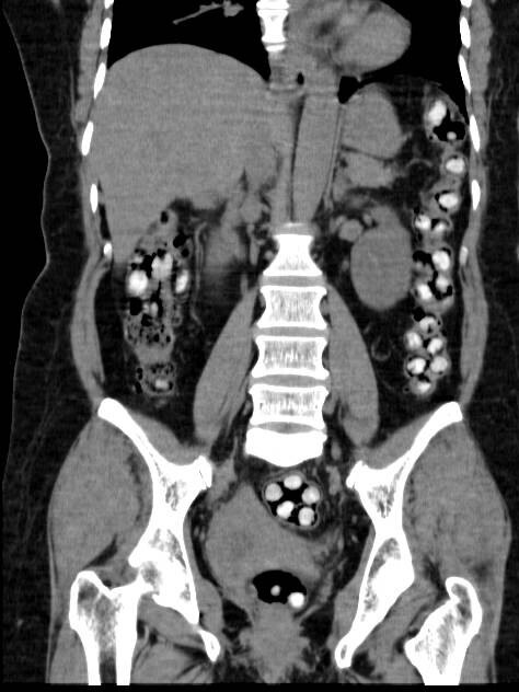 An X-ray of drugs being smuggled internally in a separate case. Picture: Supplied by the AFP