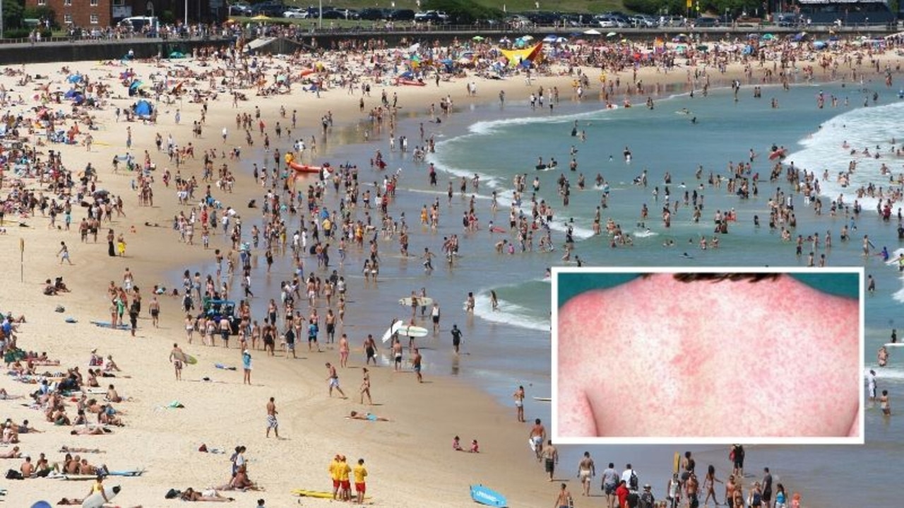 Measles: Warning After Second Case Diagnosed In NSW | News.com.au ...