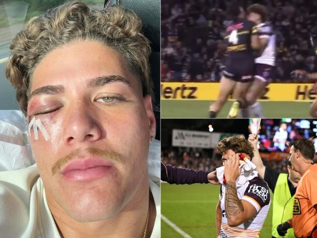 Reece Walsh suffered a facial fracture after a head clash against the Panthers.