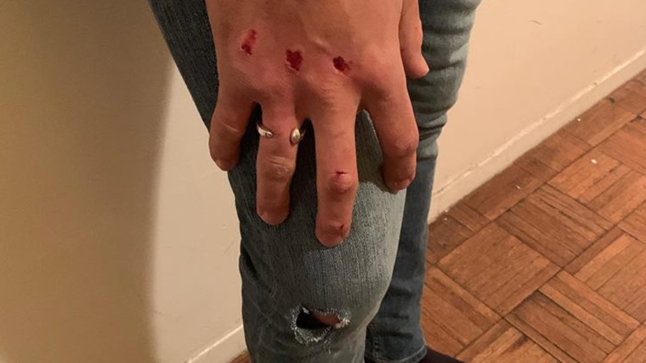 Taray Carey has shared pictures of his injuries. Picture: Facebook @