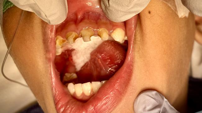 An unidentified young oral health patient from Far North Queensland who recently required surgery due to tooth decay. Picture: Supplied