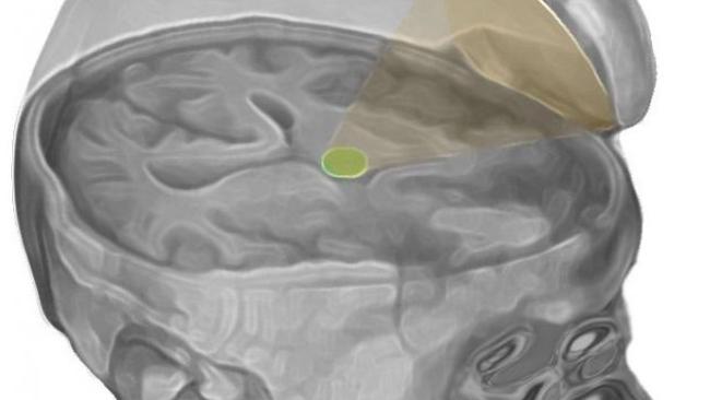 The researchers targeted the thalamus with low-intensity focused ultrasound pulsation.Picture: Martin Monti/UCLA